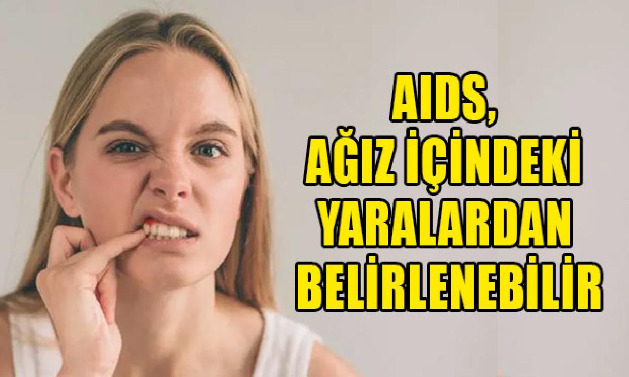 AIDS, ağız içindeki yaralardan belirlenebilir 