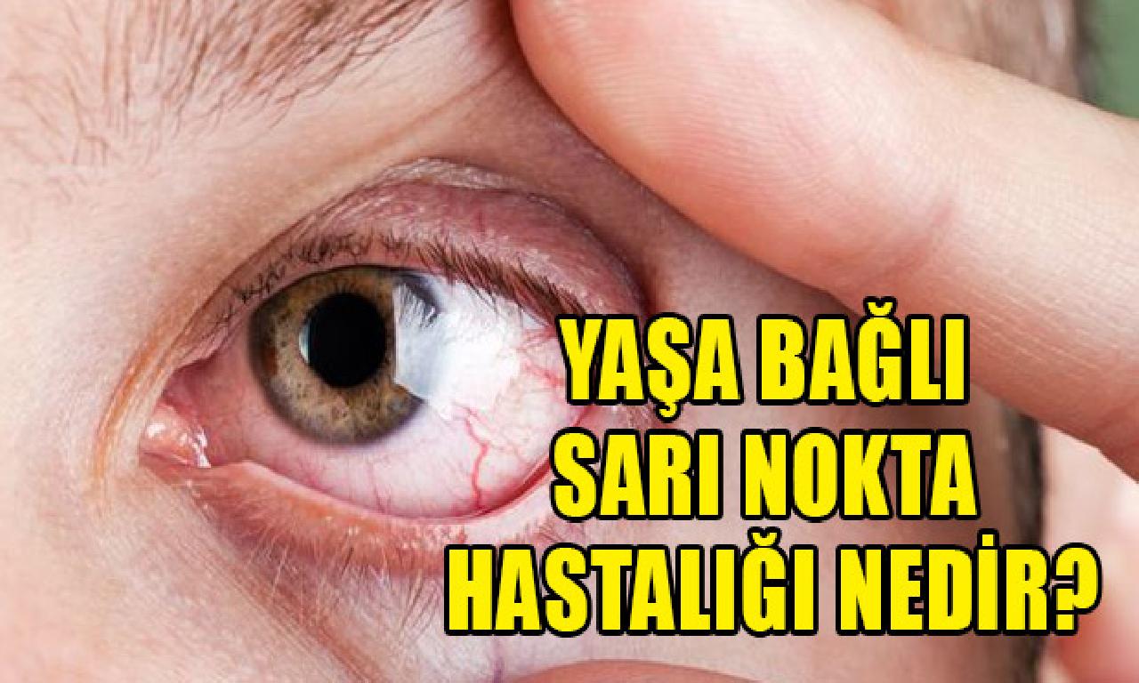 Yaşa bağlı sarı benek hastalığı nedir? 