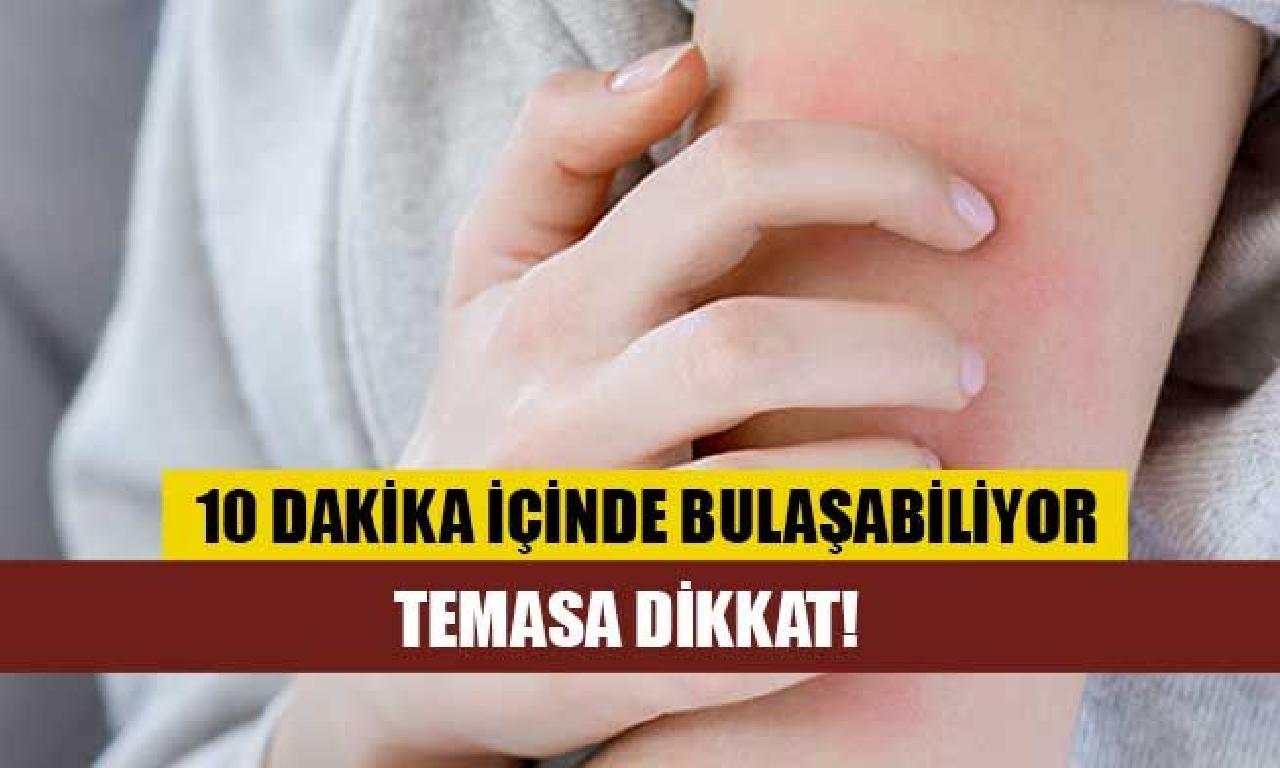 10 an içinde bulaşabiliyor: Temasa dikkat! 