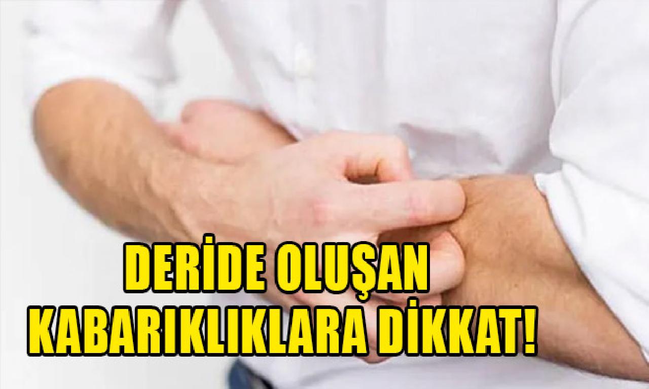 Deride oluşan kabarıklıklara dikkat! 