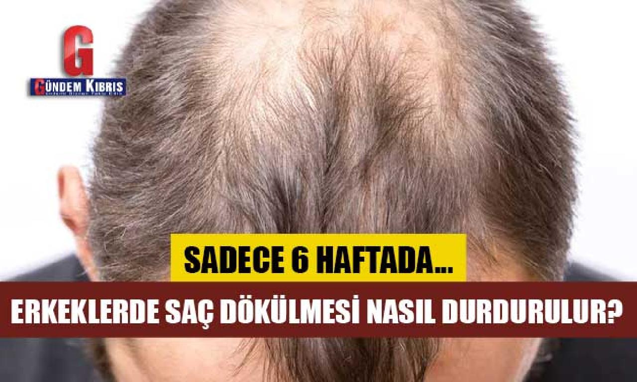 Erkeklerde saç dökülmesi nasıl durdurulur? 