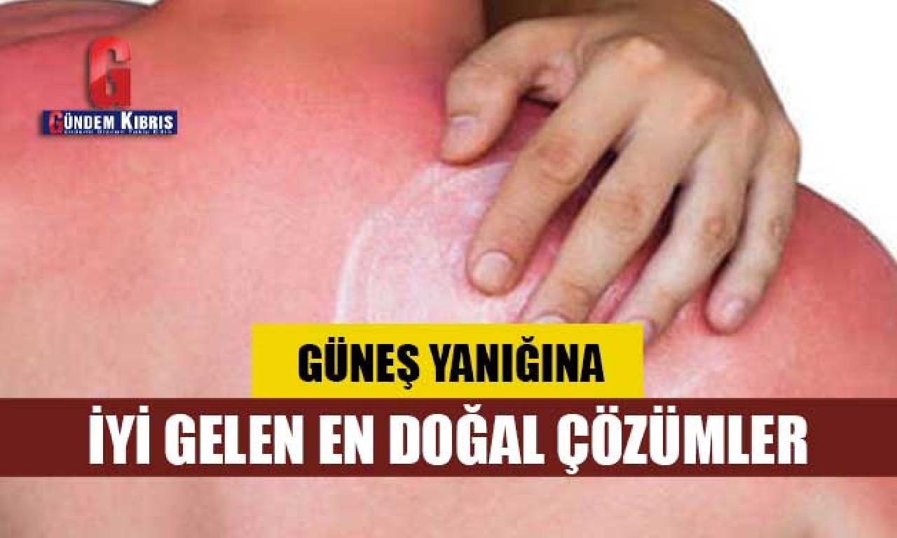 Güneş yanığına edgü mevrut genişlik doğal çözümler 