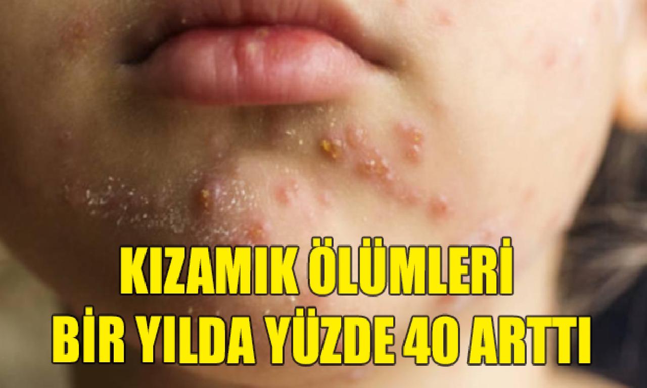 Kızamık ölümleri tek yılda yüzde 40 arttı 